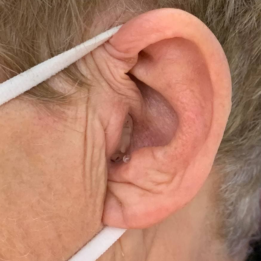 kleines Im-Ohr Hörgerät